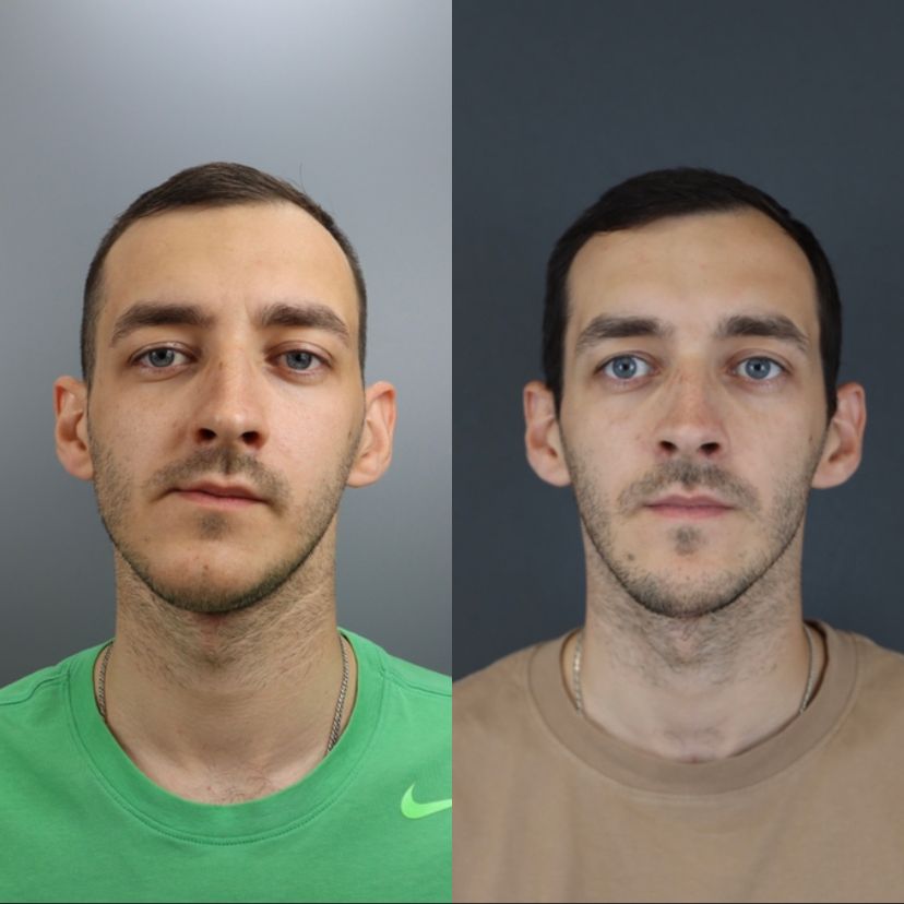 Facial asymmetry — before and after, photo 1