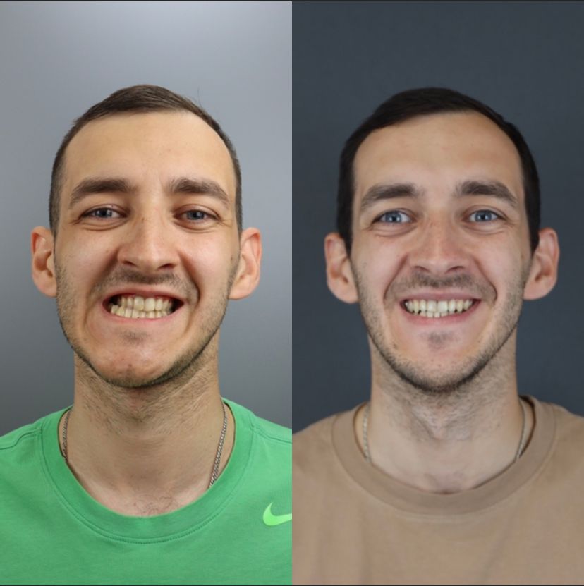 Facial asymmetry — before and after, photo 2