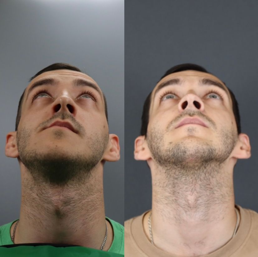 Facial asymmetry — before and after, photo 3