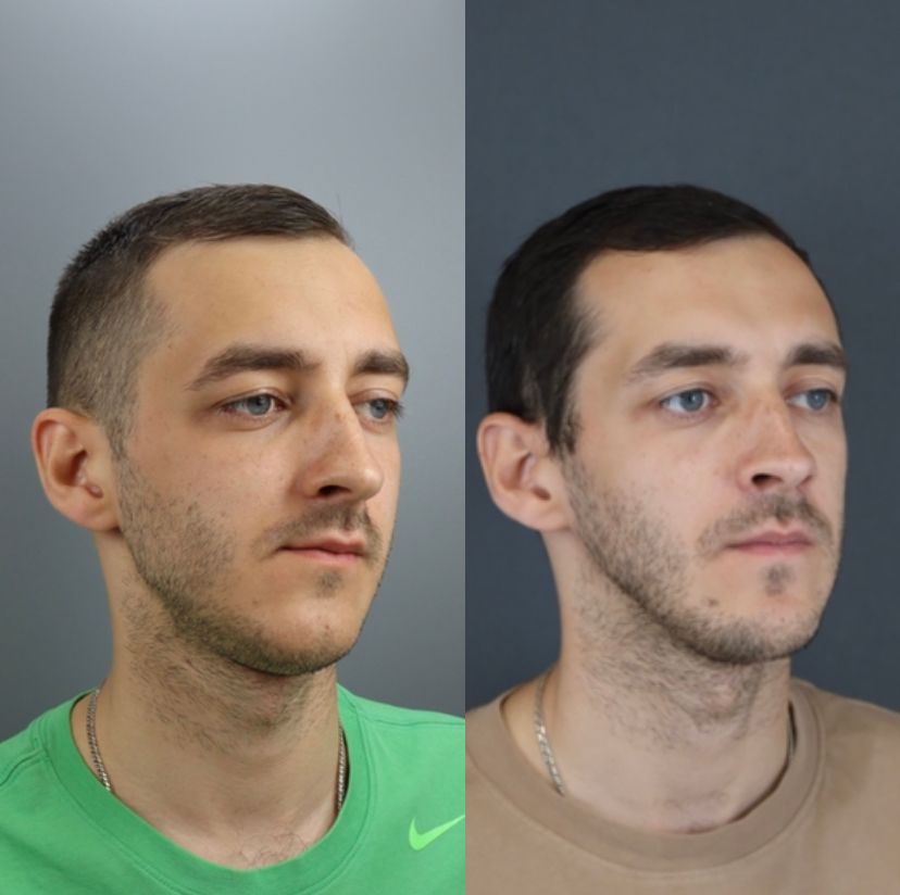 Facial asymmetry — before and after, photo 4