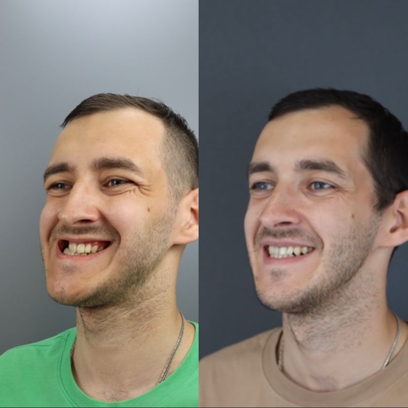 Facial asymmetry — before and after, photo 5