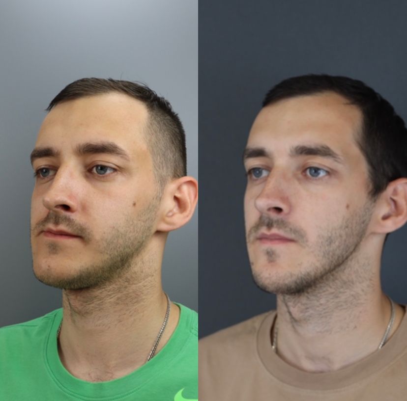 Facial asymmetry — before and after, photo 6