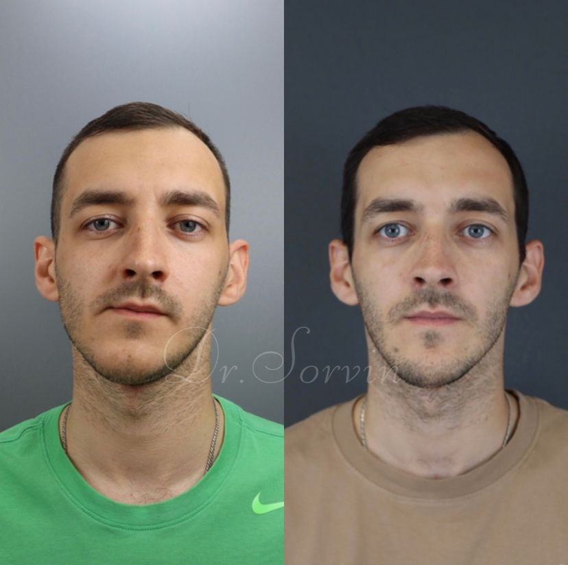 Facial asymmetry — before and after, photo 7