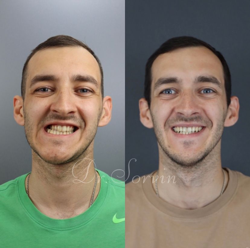 Facial asymmetry — before and after, photo 8