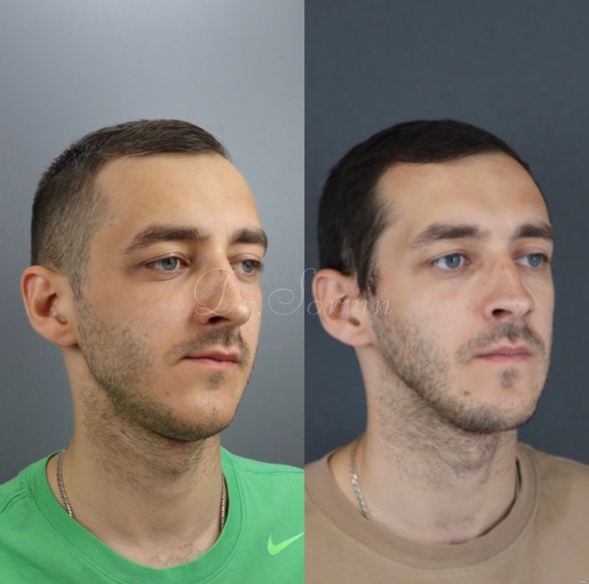 Facial asymmetry — before and after, photo 10