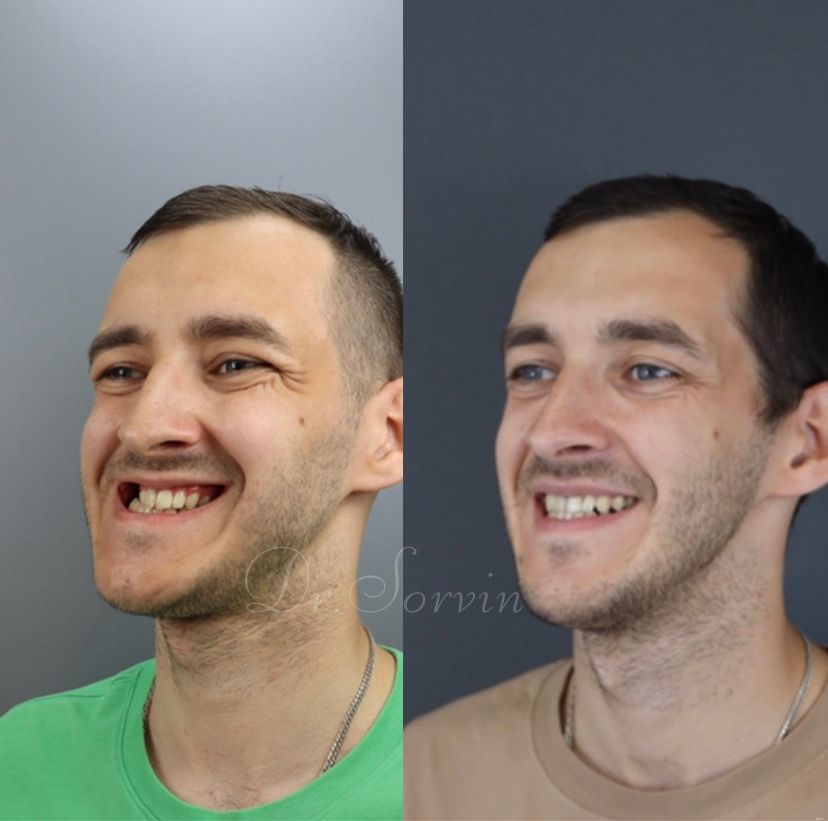 Facial asymmetry — before and after, photo 11