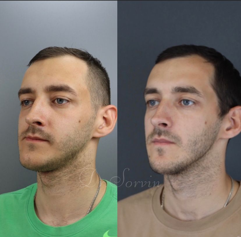 Facial asymmetry — before and after, photo 12