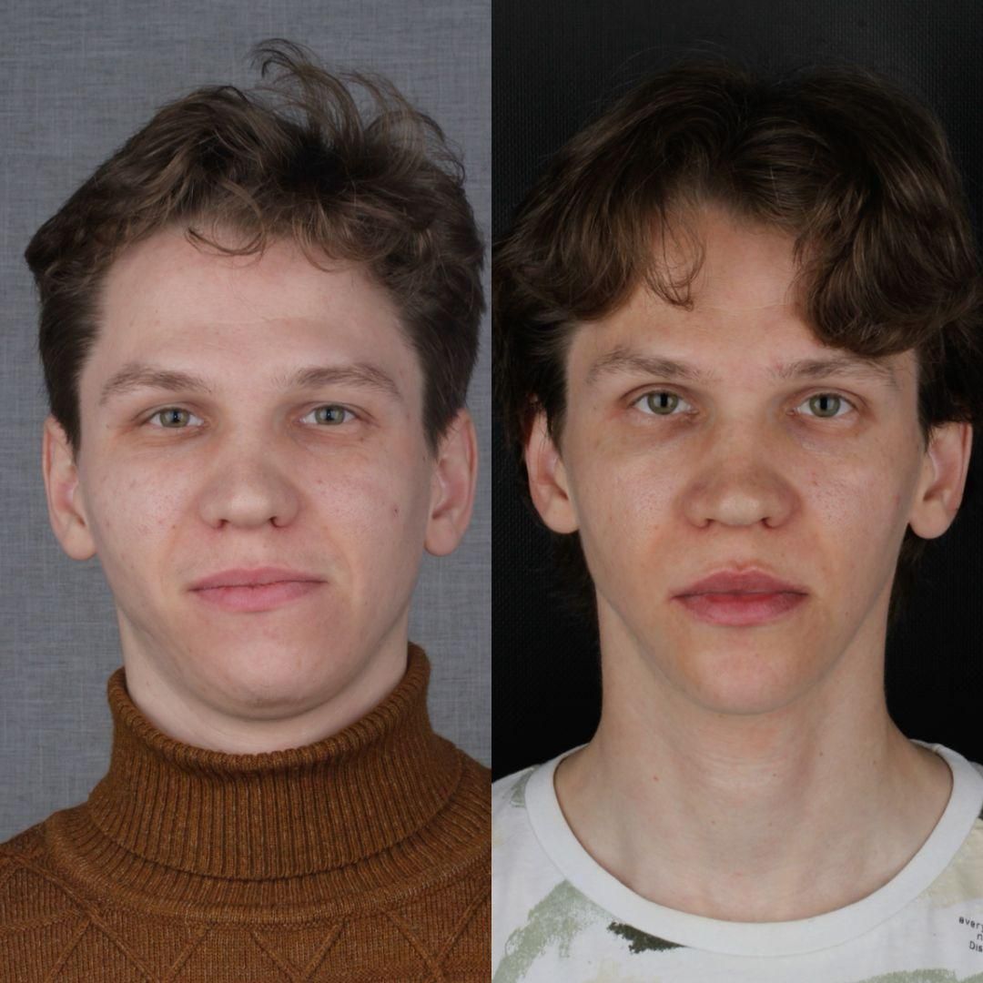 Асимметрия лица — 2 — до и после, кадр 21