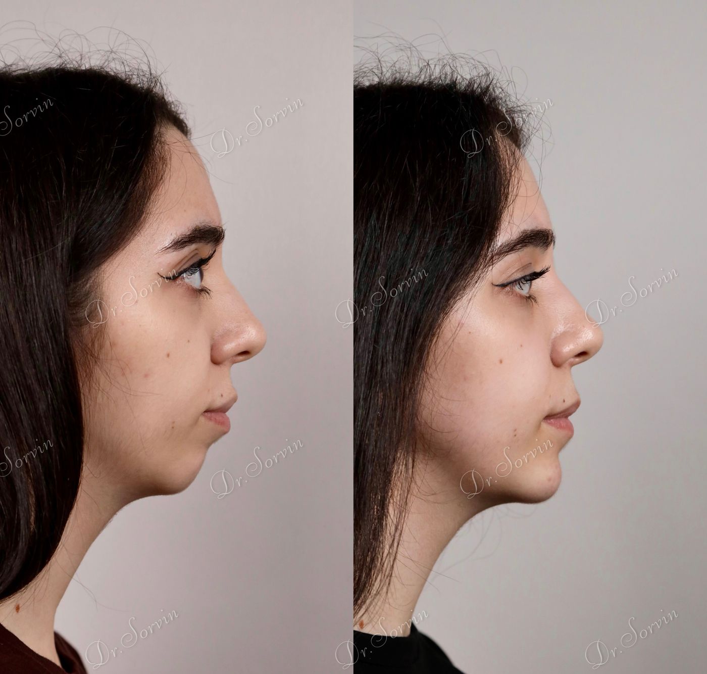 Class II skeletal malocclusion — before and after, photo 1