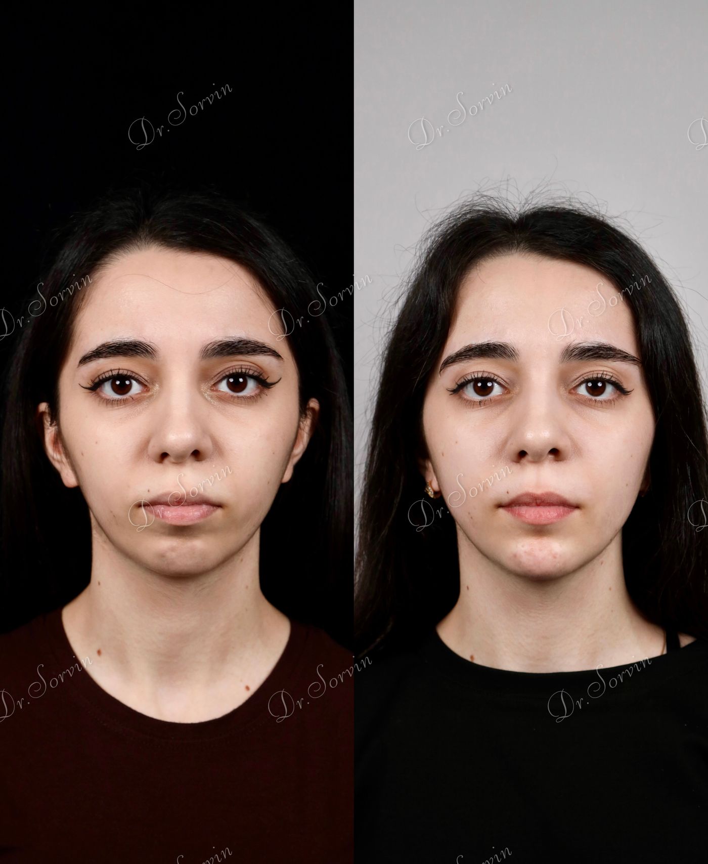 Class II skeletal malocclusion — before and after, photo 2