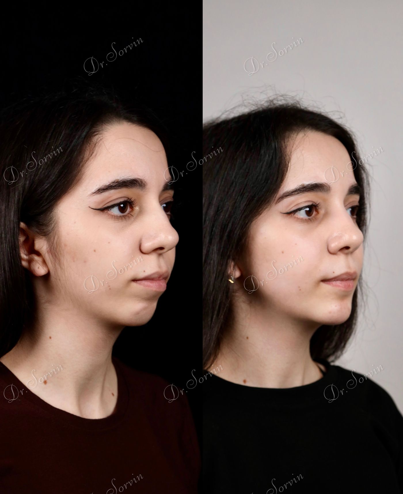 Class II skeletal malocclusion — before and after, photo 3