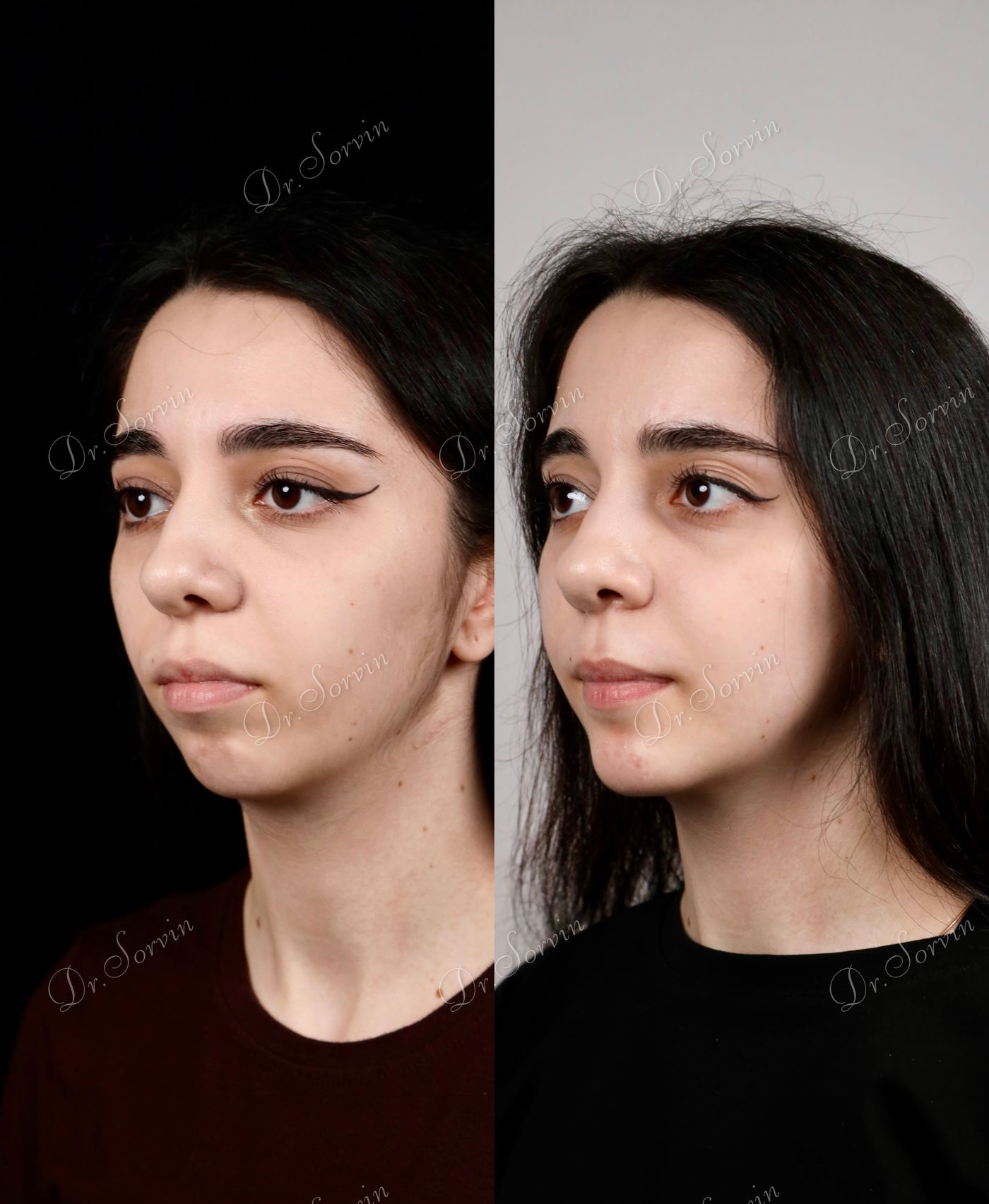 Class II skeletal malocclusion — before and after, photo 4
