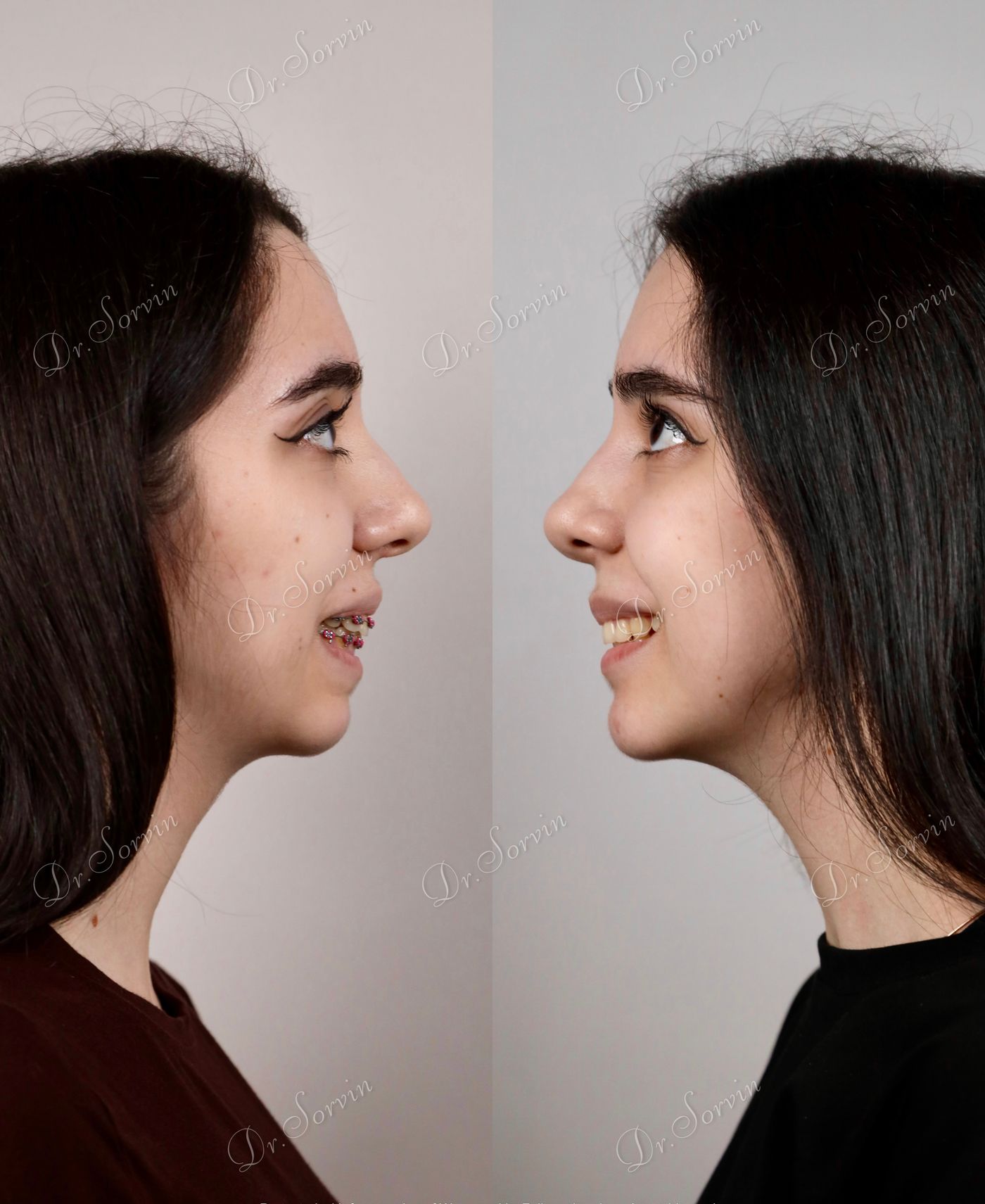 Class II skeletal malocclusion — before and after, photo 5