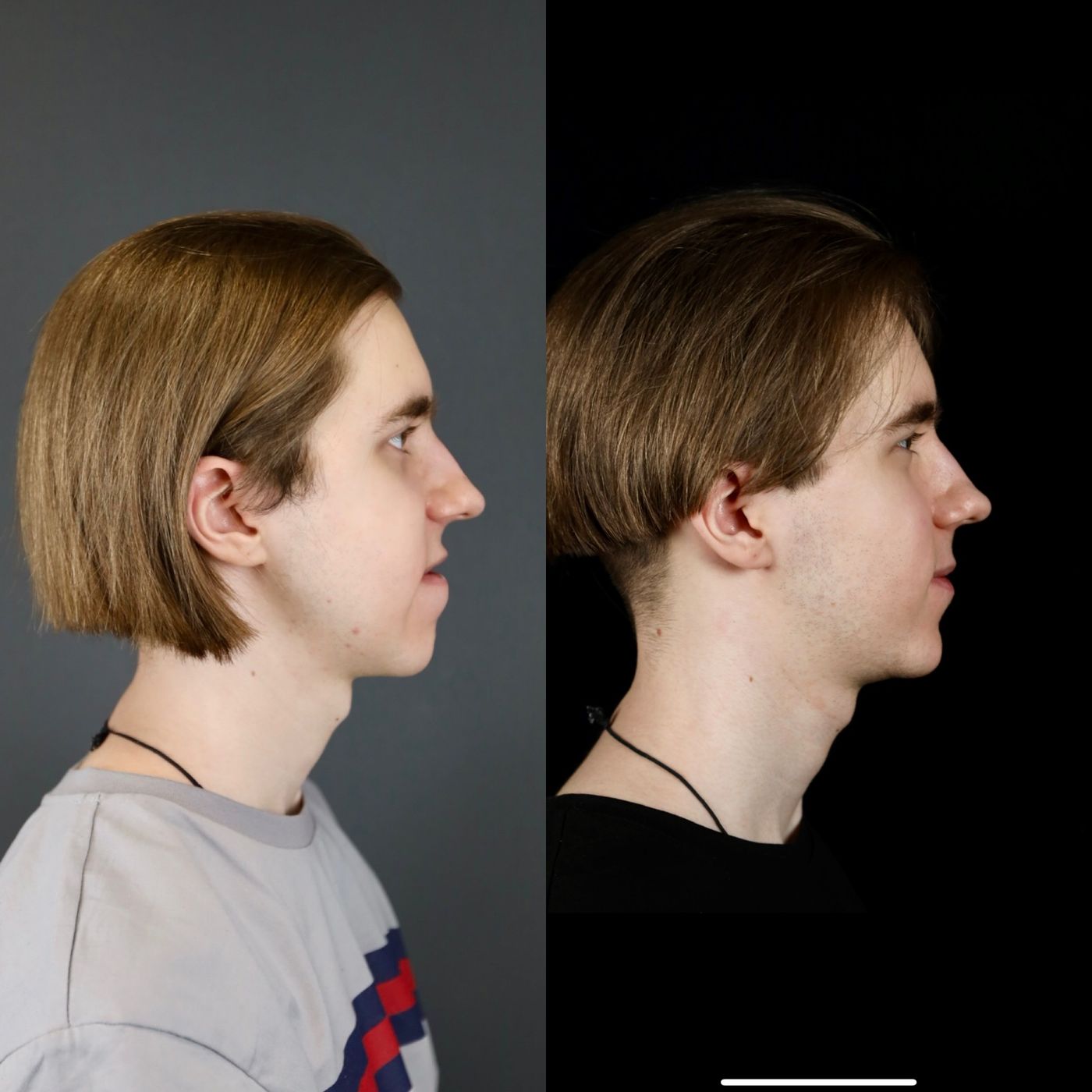 Class III skeletal malocclusion — before and after, photo 1