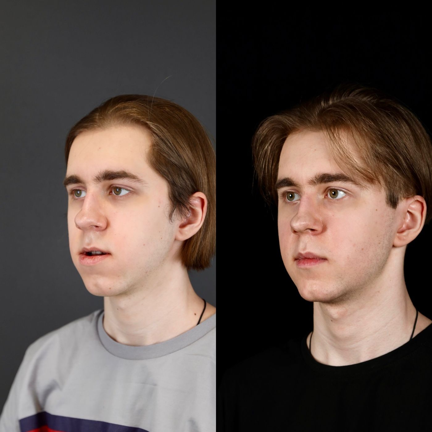 Class III skeletal malocclusion — before and after, photo 2