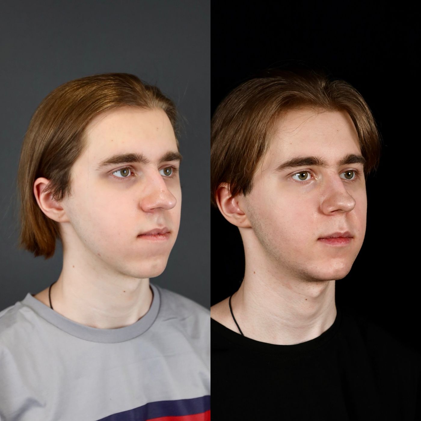 Class III skeletal malocclusion — before and after, photo 3