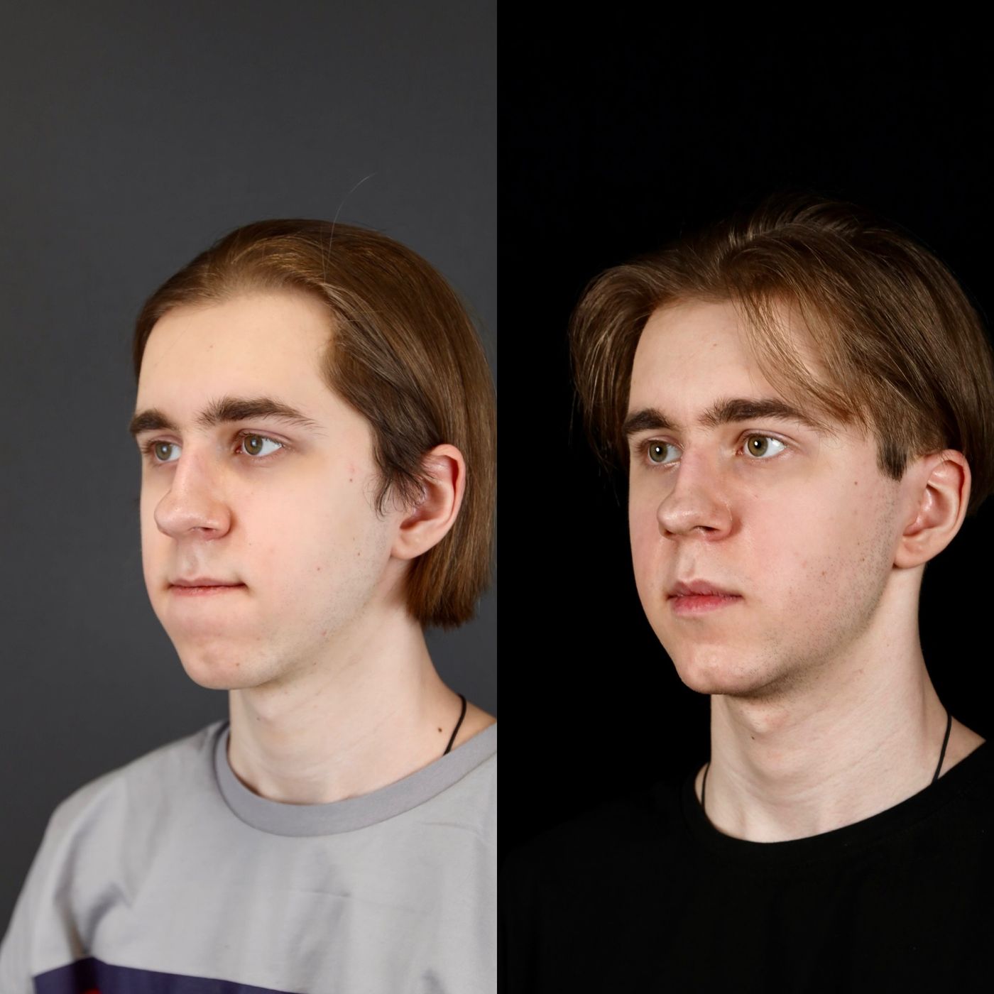 Class III skeletal malocclusion — before and after, photo 5