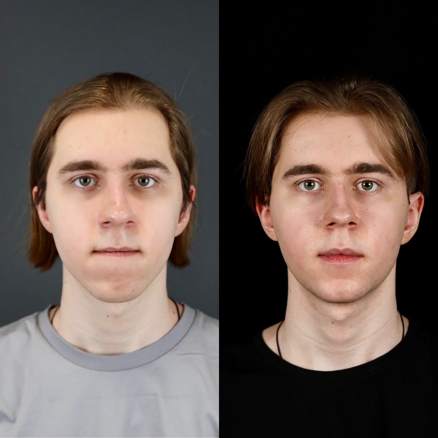Class III skeletal malocclusion — before and after, photo 6
