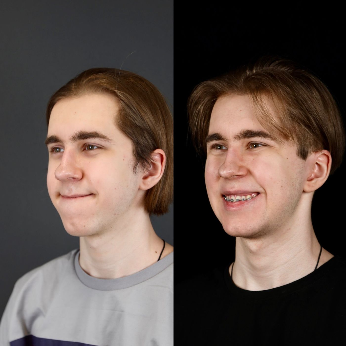 Class III skeletal malocclusion — before and after, photo 7