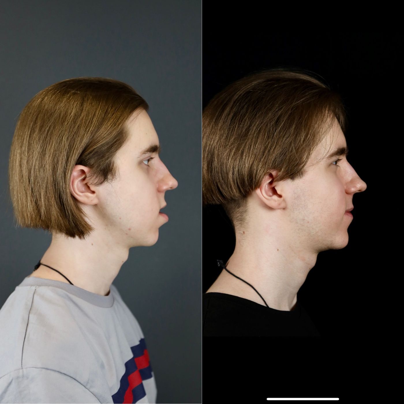 Class III skeletal malocclusion — before and after, photo 8