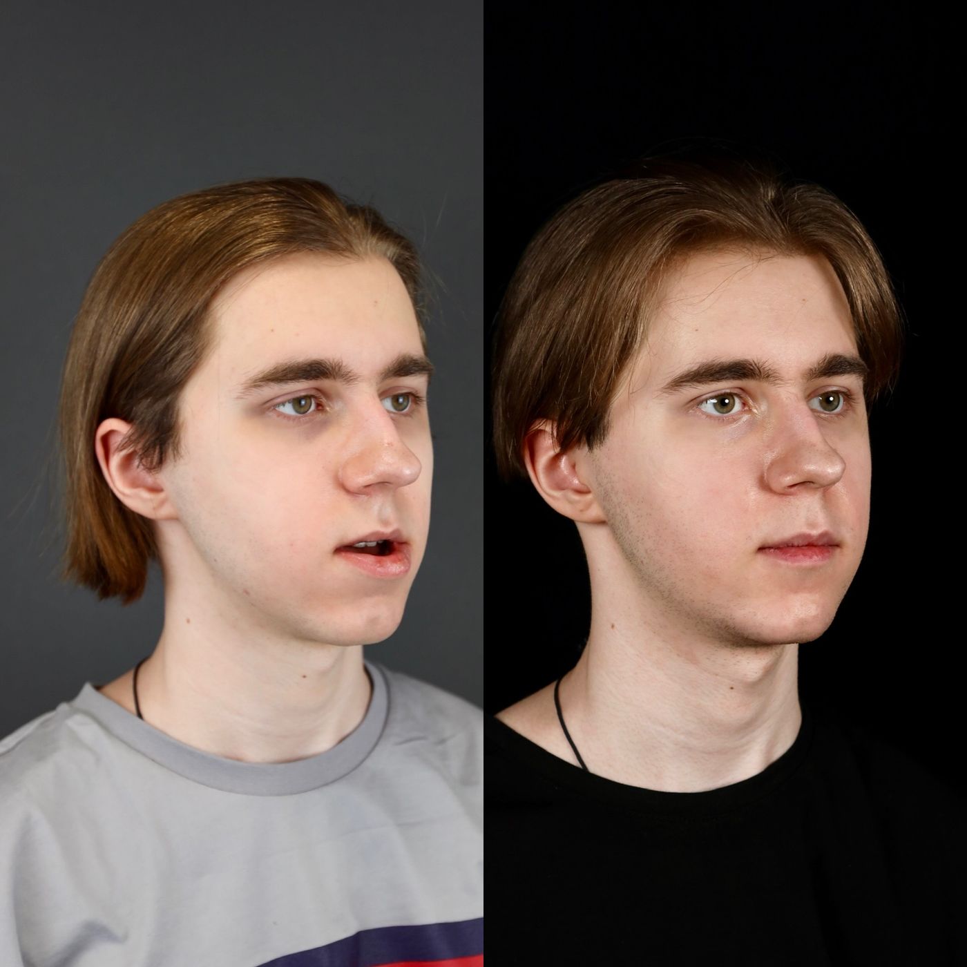 Class III skeletal malocclusion — before and after, photo 9