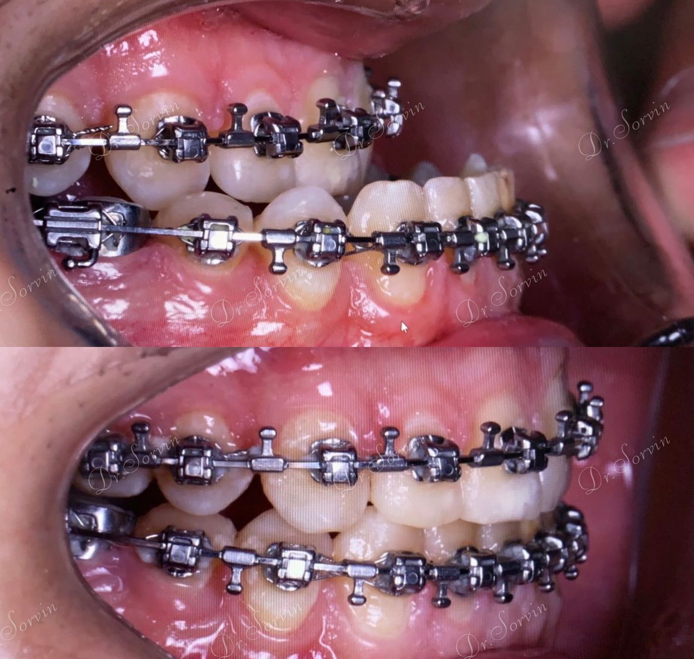 Class III skeletal malocclusion — before and after, photo 10