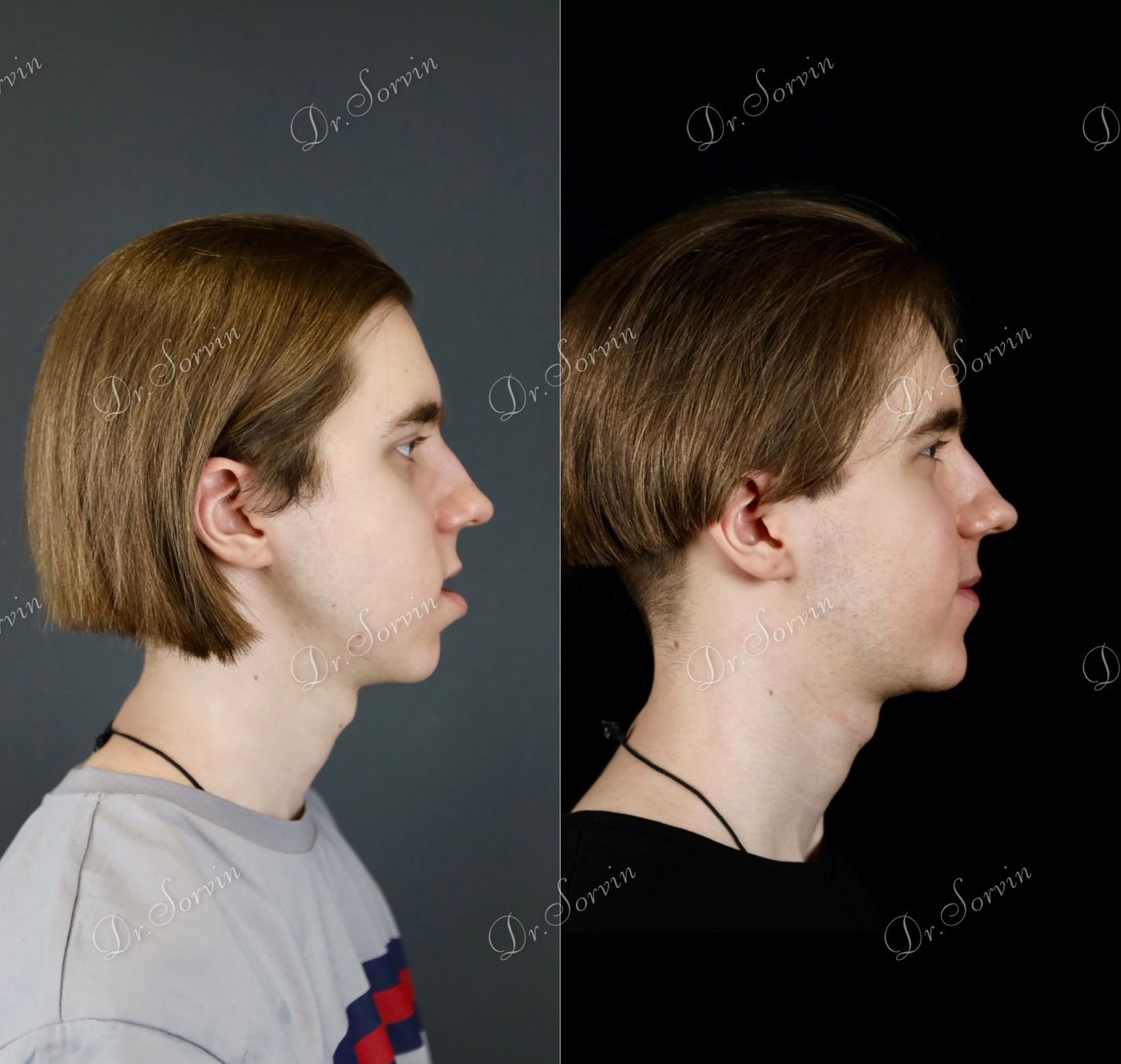 Class III skeletal malocclusion — before and after, photo 11