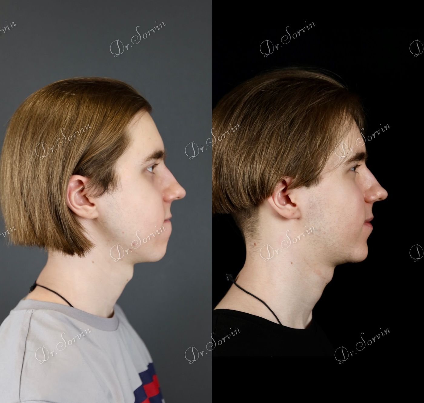 Class III skeletal malocclusion — before and after, photo 12