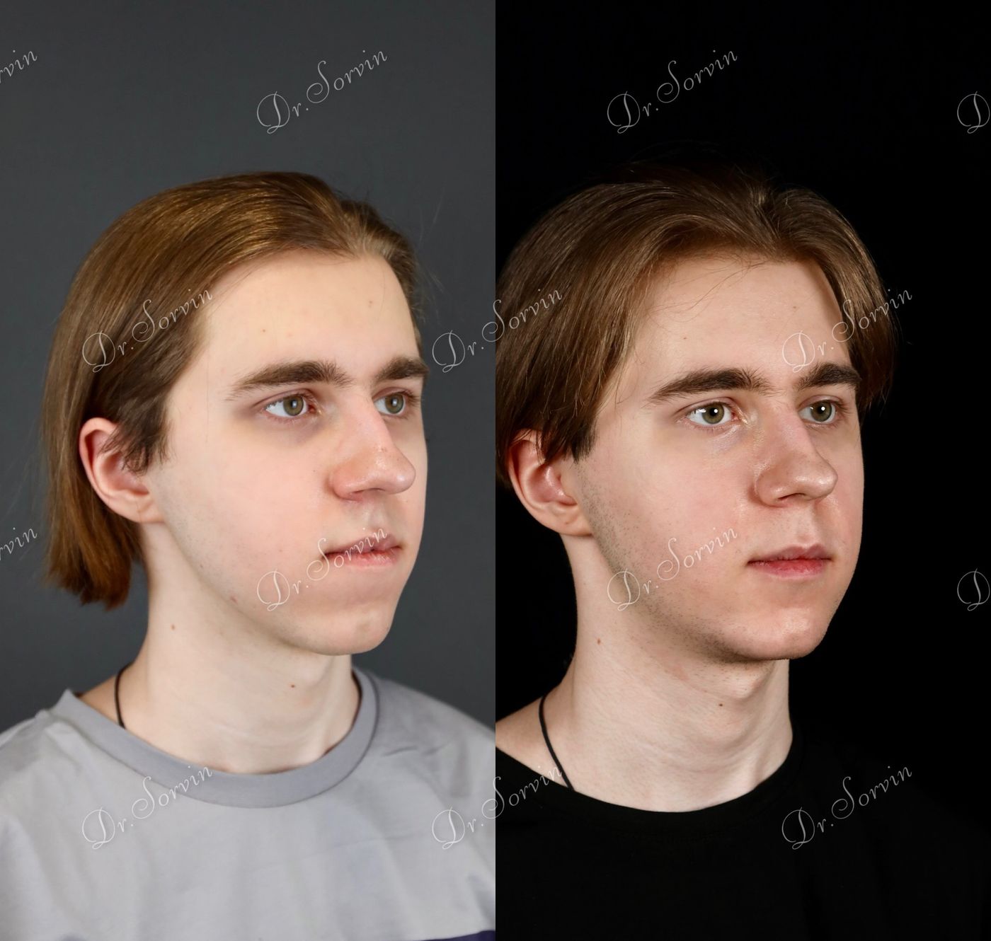 Class III skeletal malocclusion — before and after, photo 13