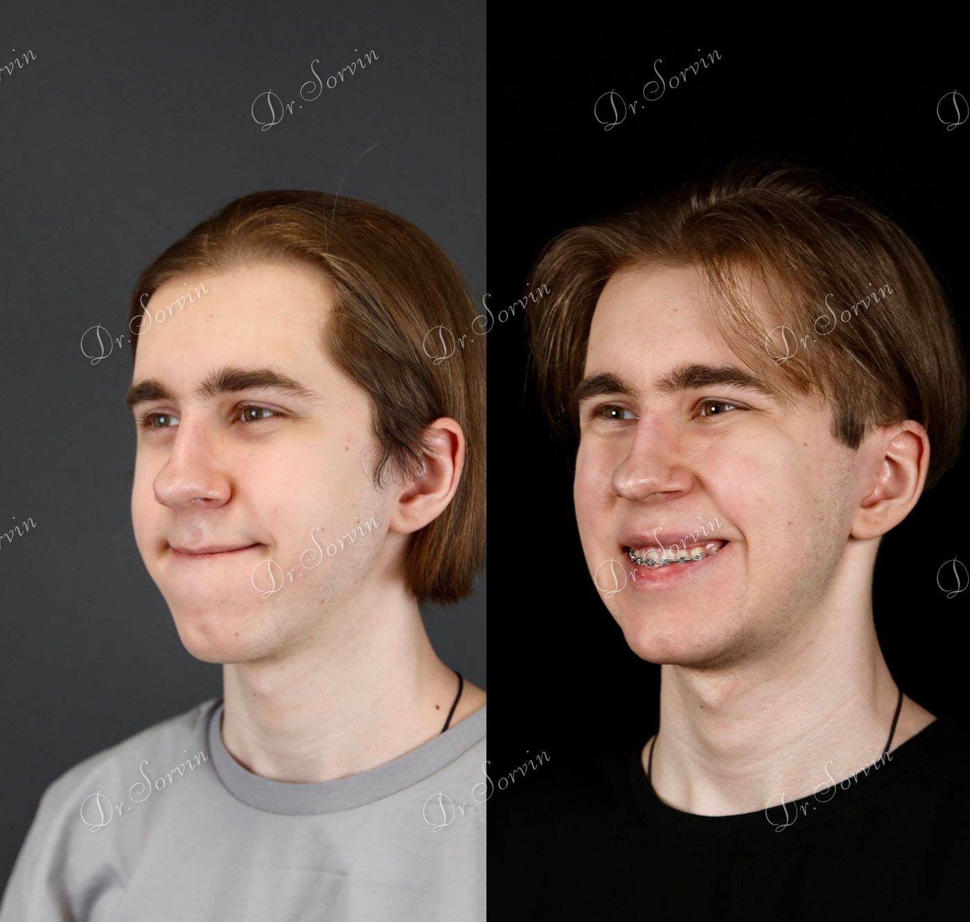 Class III skeletal malocclusion — before and after, photo 14