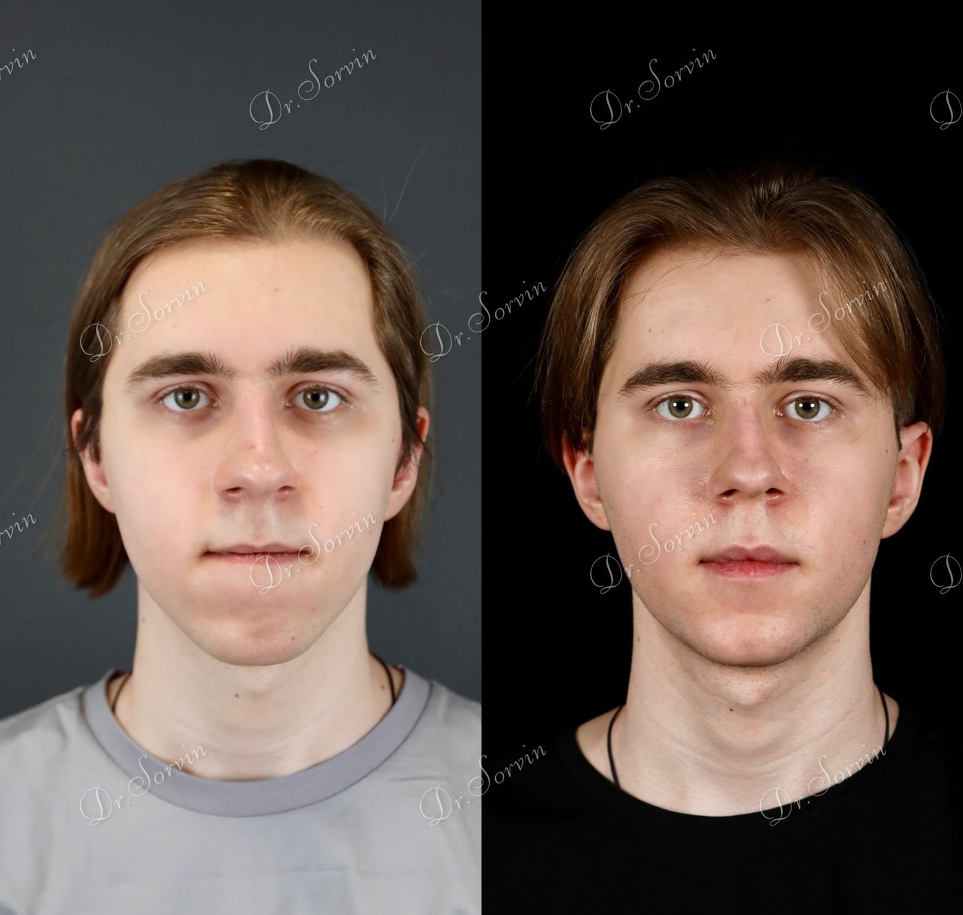 Class III skeletal malocclusion — before and after, photo 15