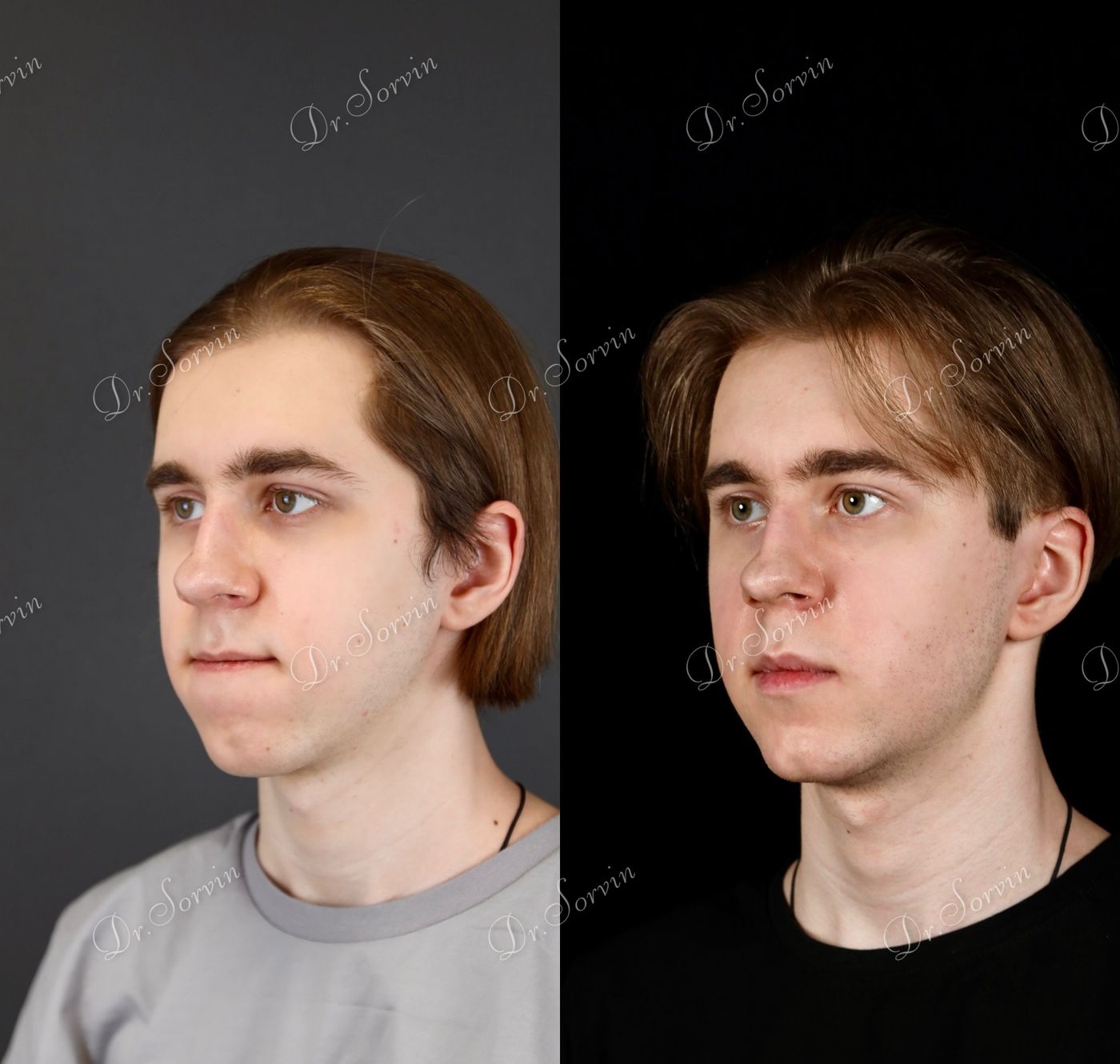 Class III skeletal malocclusion — before and after, photo 16