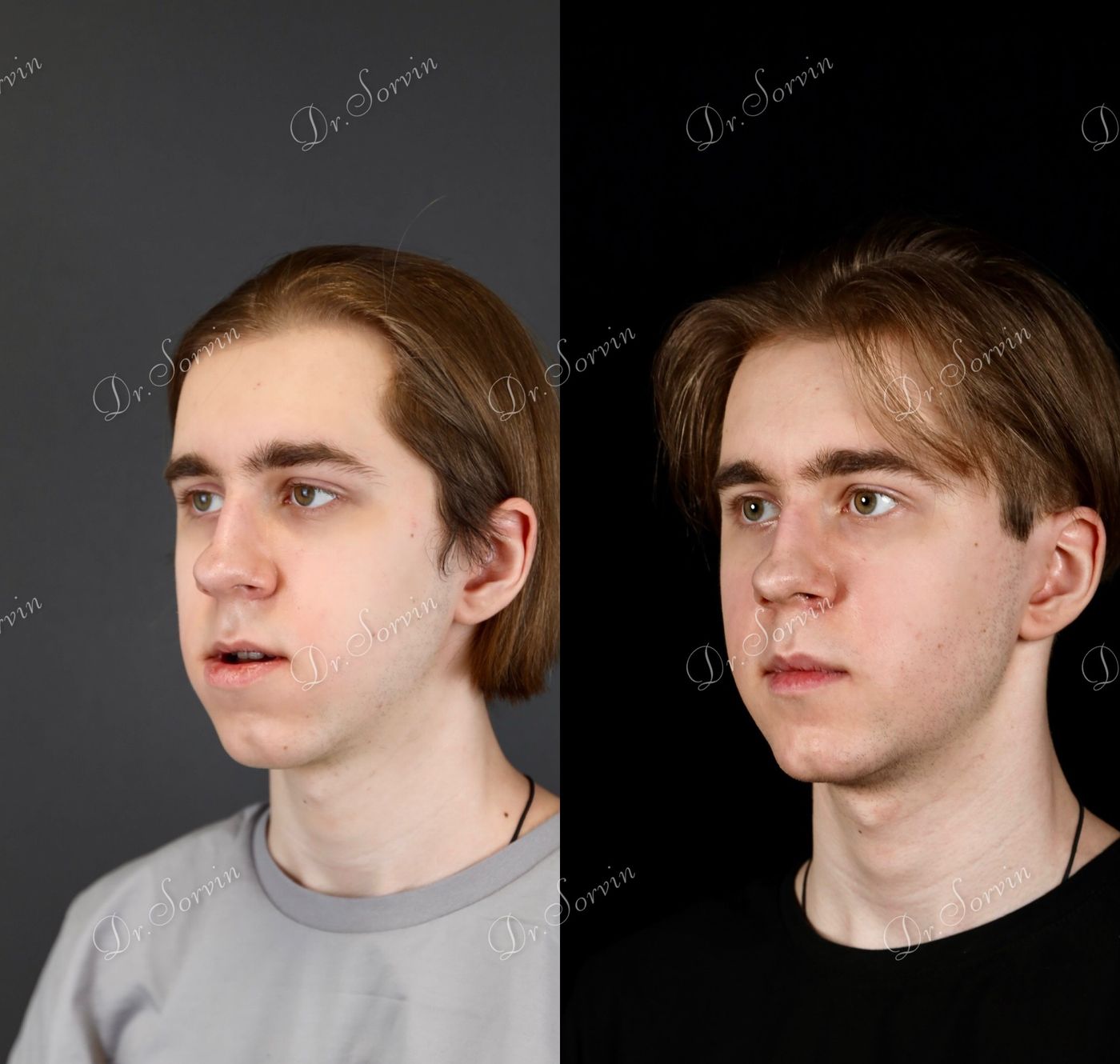 Class III skeletal malocclusion — before and after, photo 17