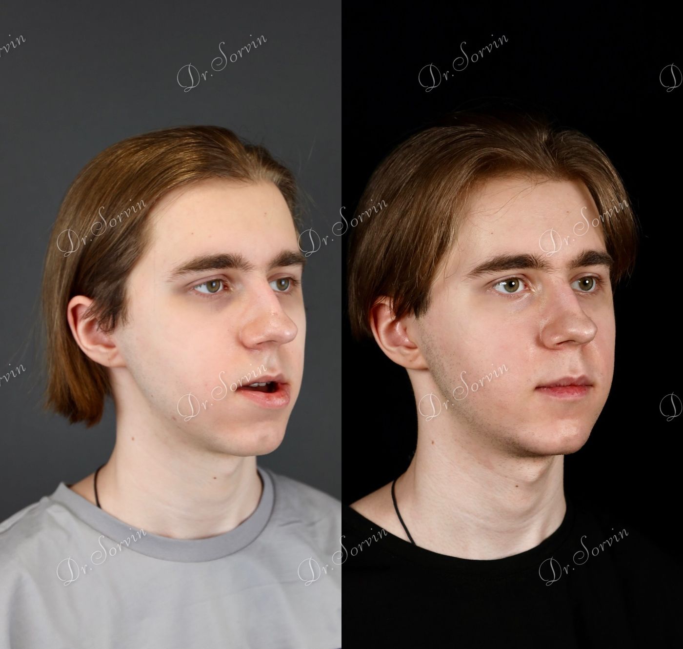 Class III skeletal malocclusion — before and after, photo 18
