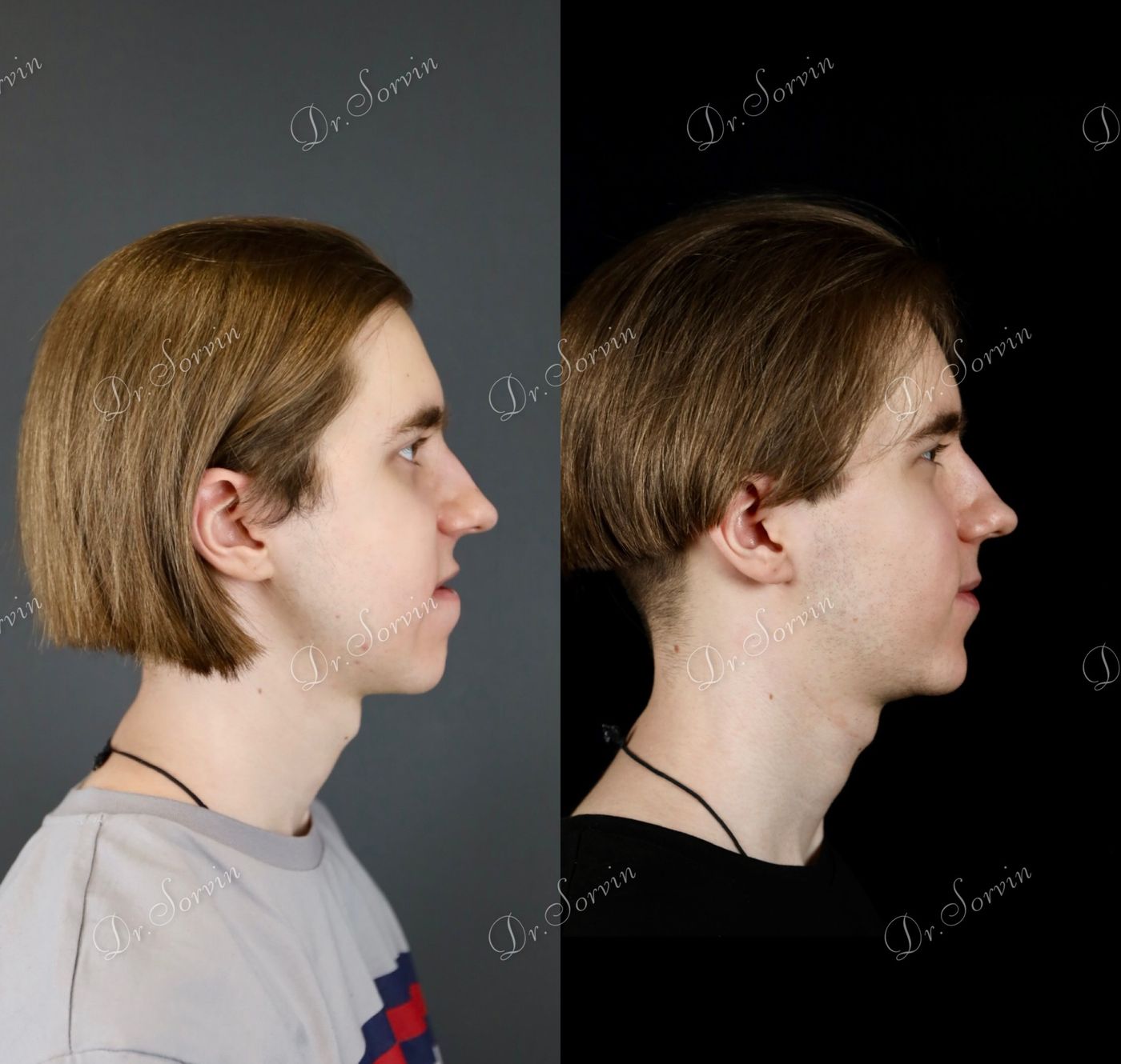Class III skeletal malocclusion — before and after, photo 19