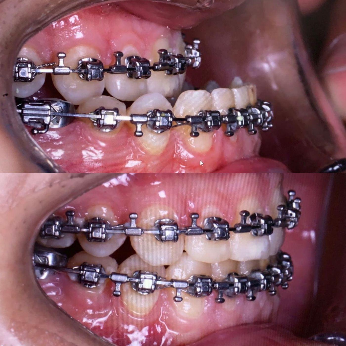 Class III skeletal malocclusion — before and after, photo 20