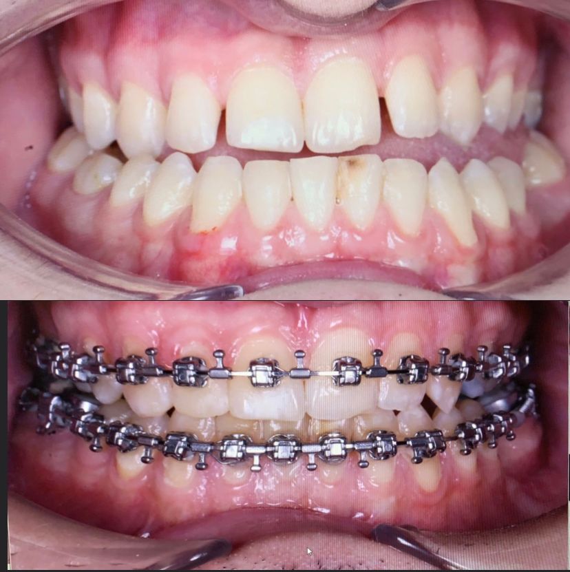 Class III skeletal malocclusion — before and after, photo 21