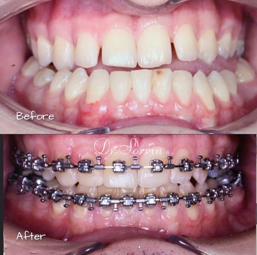 Class III skeletal malocclusion — before and after, photo 22