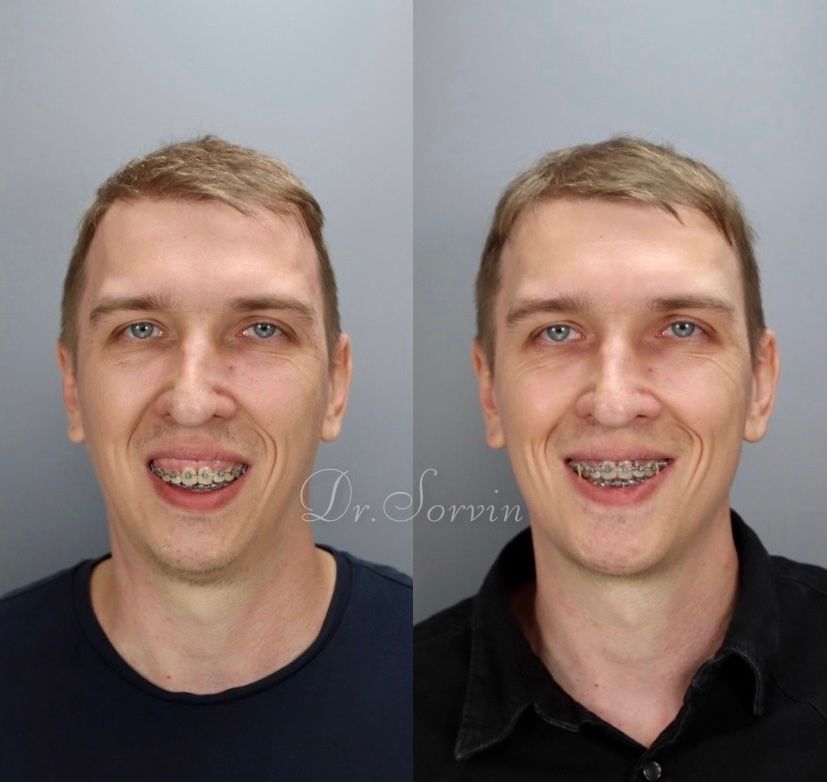 Class II skeletal malocclusion — 3 — before and after, photo 1