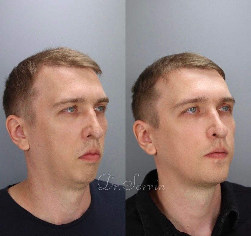Class II skeletal malocclusion — 3 — before and after, photo 2