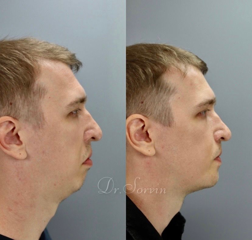 Class II skeletal malocclusion — 3 — before and after, photo 3