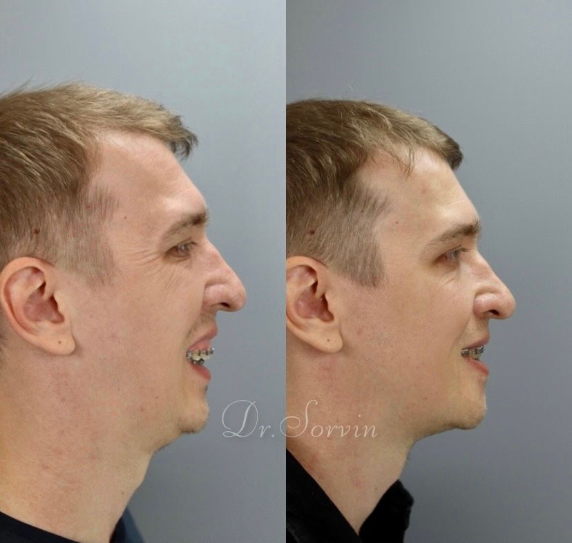 Class II skeletal malocclusion — 3 — before and after, photo 4
