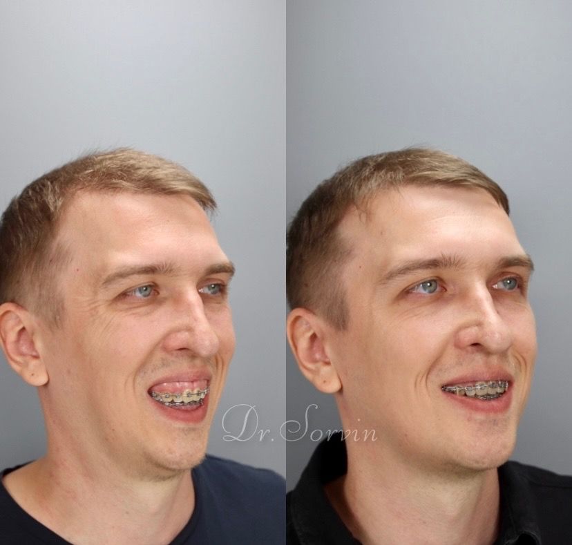 Class II skeletal malocclusion — 3 — before and after, photo 5