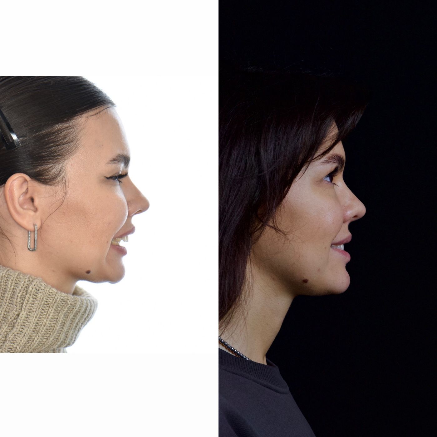 Class II skeletal malocclusion — 4 — before and after, photo 1