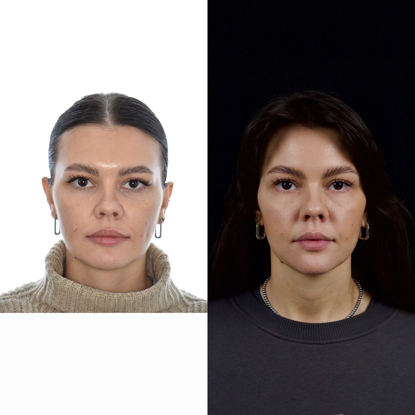 Class II skeletal malocclusion — 4 — before and after, photo 2