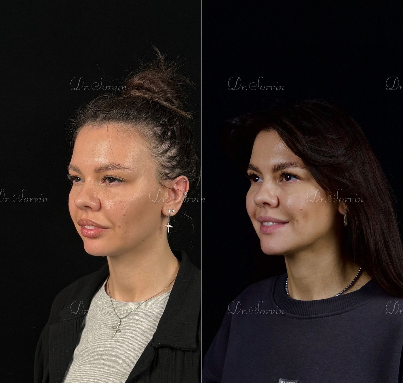 Class II skeletal malocclusion — 4 — before and after, photo 4
