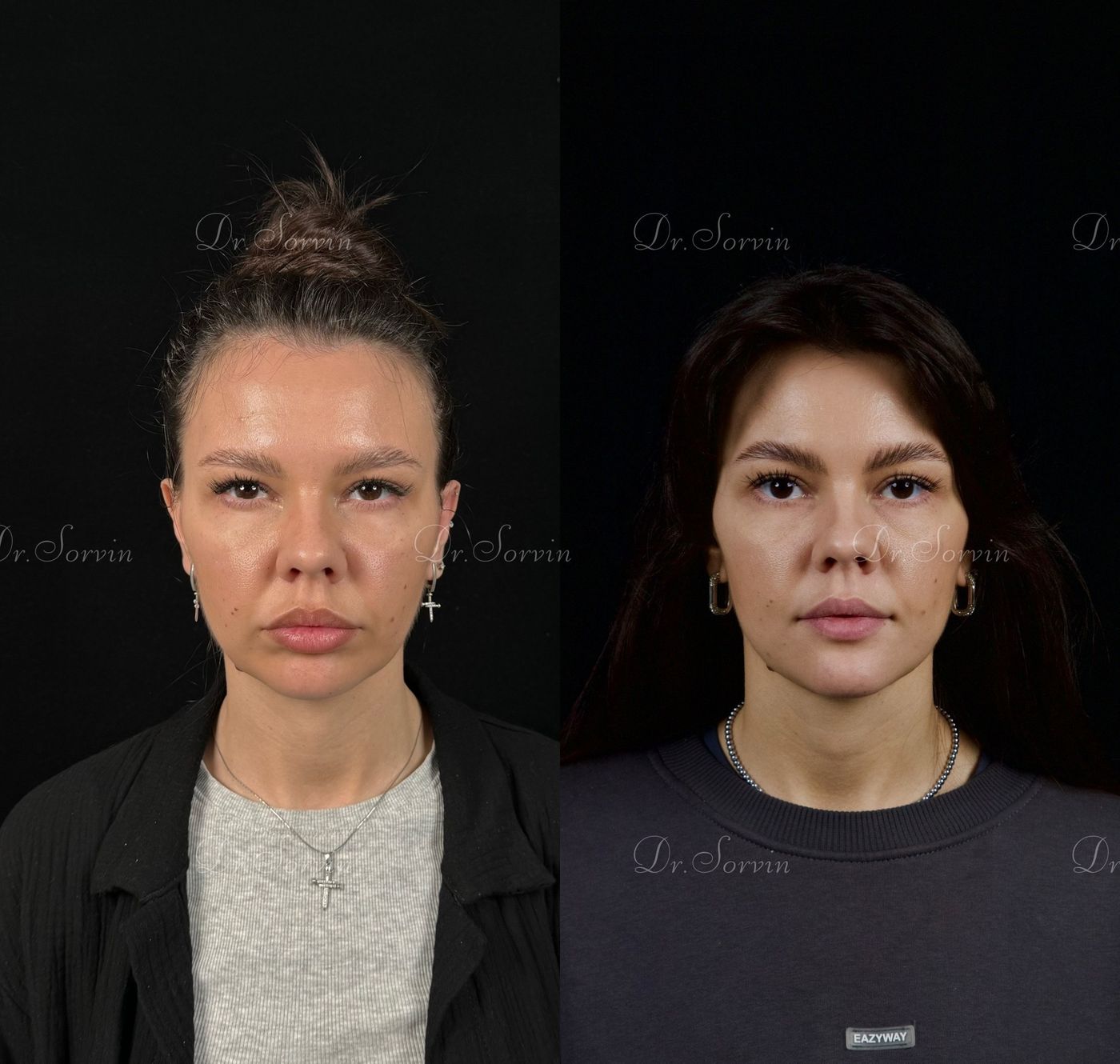 Class II skeletal malocclusion — 4 — before and after, photo 6