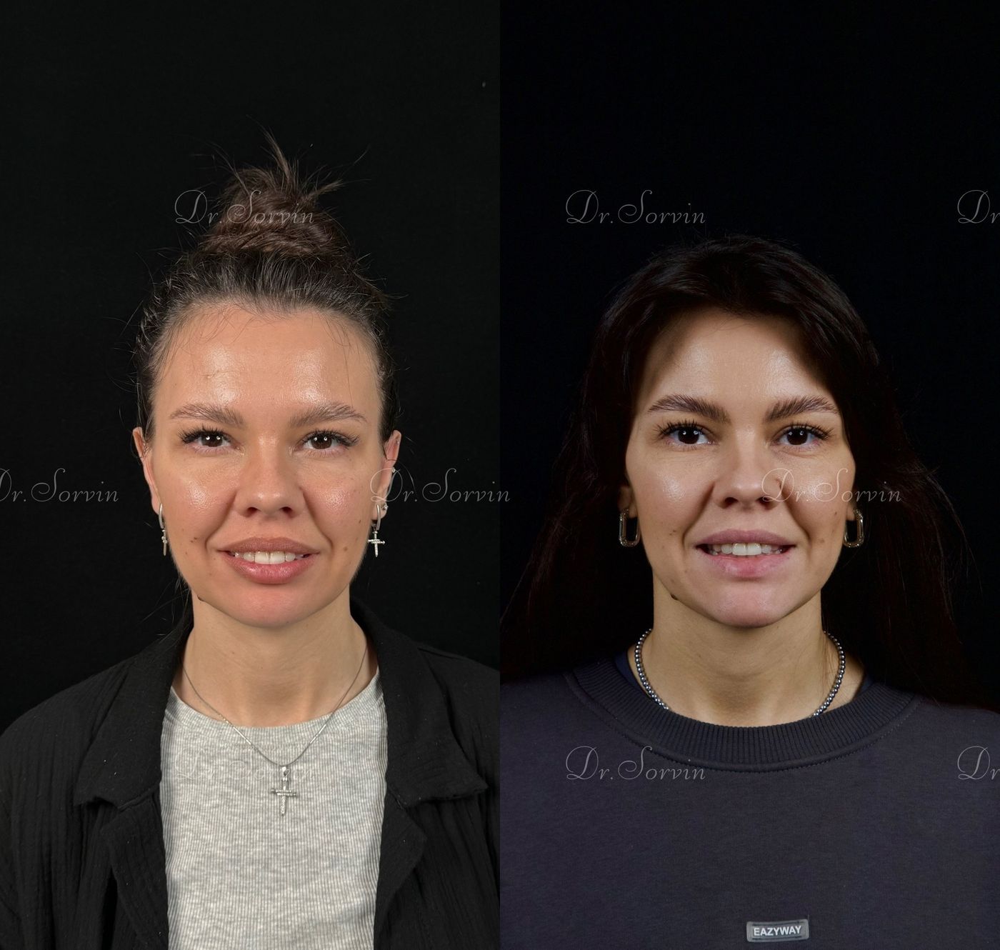 Class II skeletal malocclusion — 4 — before and after, photo 7