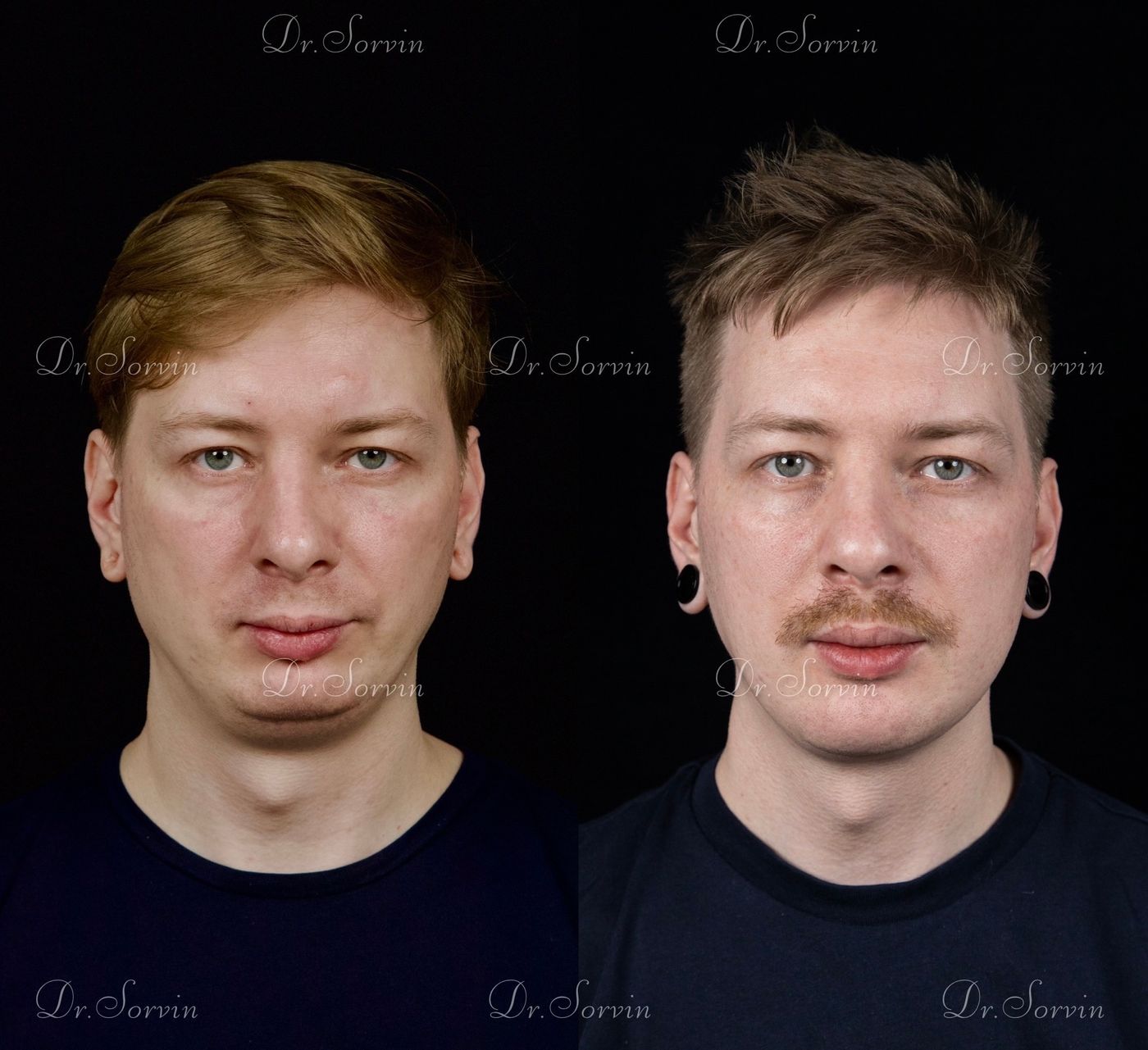 Class II skeletal malocclusion — 6 — before and after, photo 1
