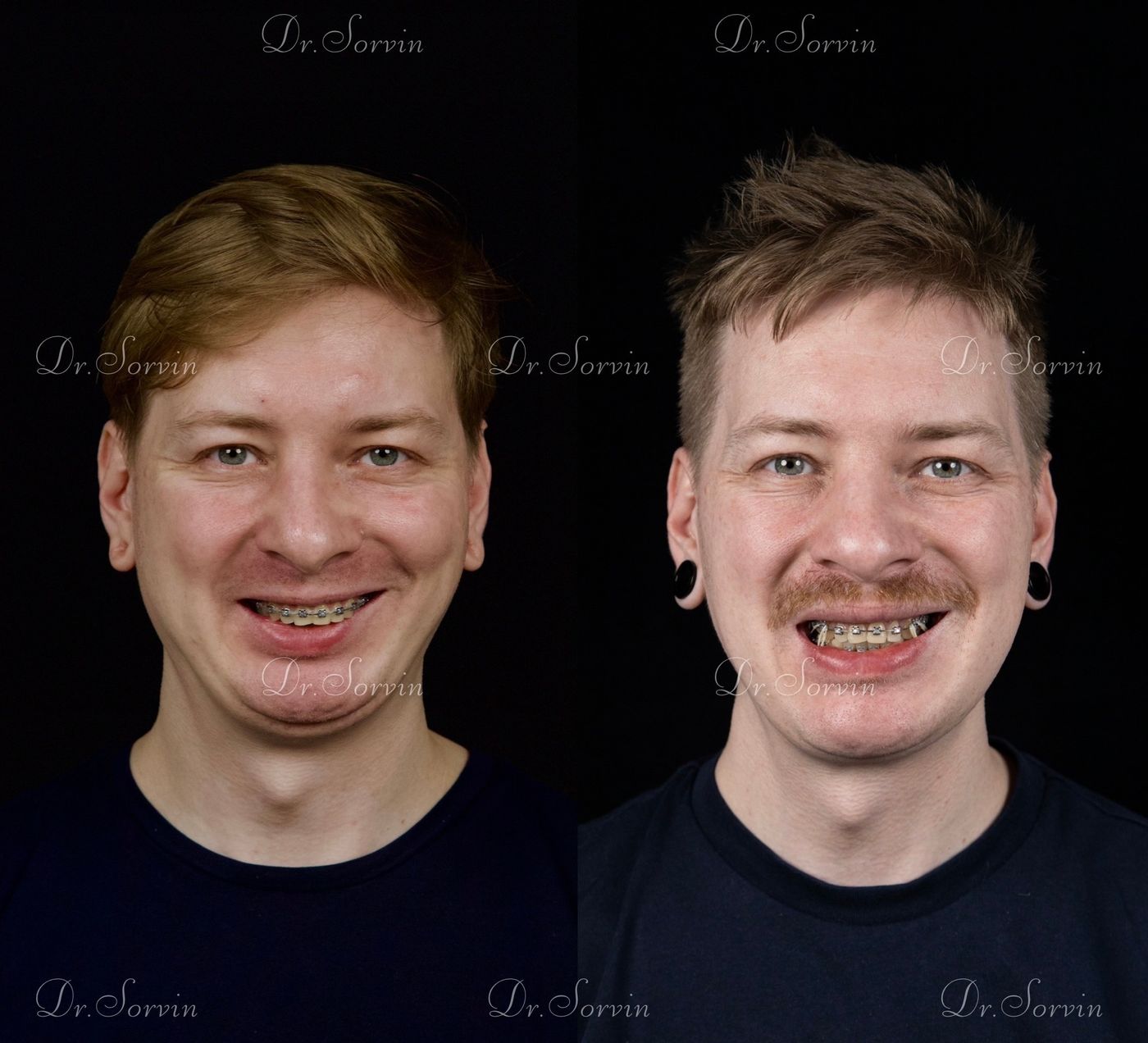 Class II skeletal malocclusion — 6 — before and after, photo 2